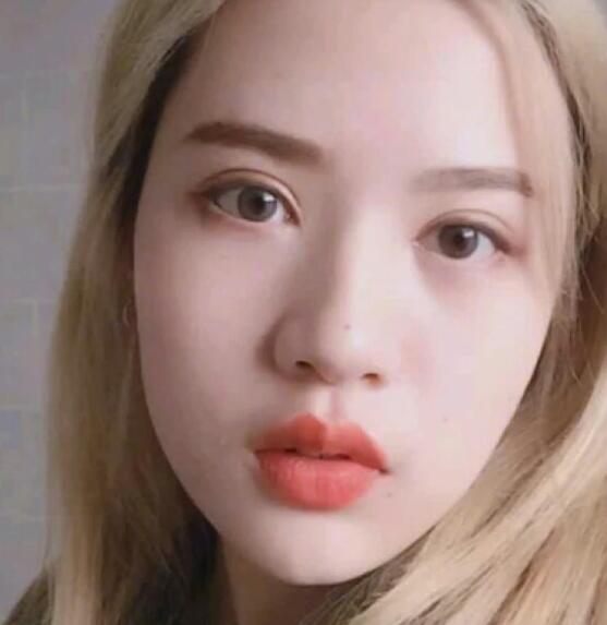 廣州中科美整形陳昌華雙下巴吸脂案例分享