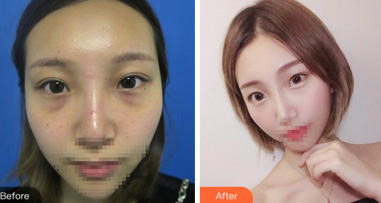 安徽省立醫(yī)院褚燕軍手術祛眼袋術后一個月效果分享