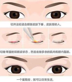 廣州廣大整形美容醫(yī)院切開雙眼皮術后效果