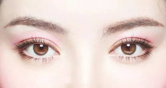 貴陽華美整形美容埋線雙眼皮術(shù)后效果