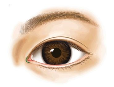 海南華美醫(yī)學(xué)美容醫(yī)院開眼角術(shù)后效果