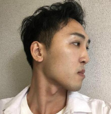 成都恩喜醫(yī)學整形張曉琴醫(yī)生男性過大下頜角磨骨案例效果分享