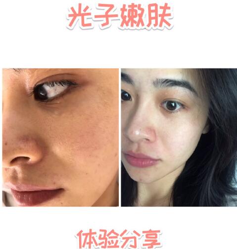 福州愛思特比華利整形林秋蓉醫(yī)生做光子嫩膚過程體驗(yàn)