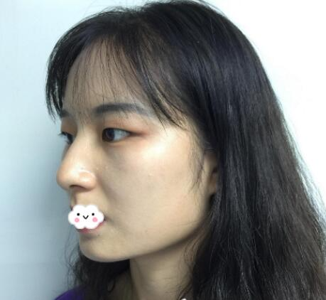 北京玲瓏梵宮整形醫(yī)生張蔚宣下頜角案例100天效果對比圖