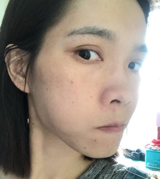 北京藝星整形專家廖苑利做光子嫩膚怎么樣？廖苑利光子嫩膚案例效果展示