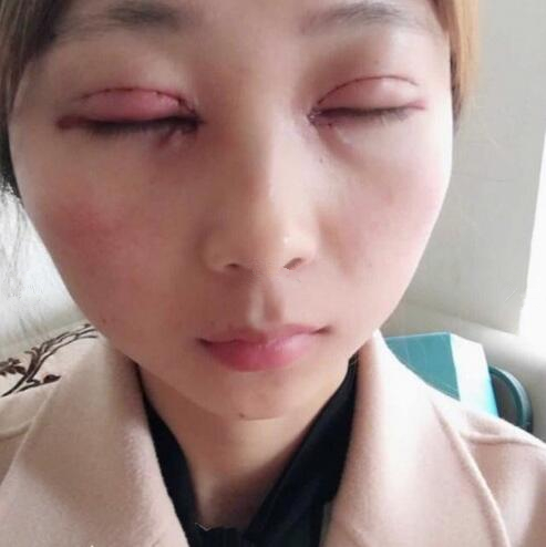 切開(kāi)雙眼皮案例分享