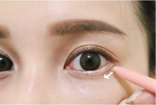 泉州脂管加醫(yī)療美容門診部吸脂祛眼袋