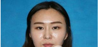 安徽立新整形專家朱慧茹做膠原蛋白豐唇怎么樣？朱慧茹膠原蛋白豐唇案例對比圖