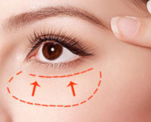 泉州億星醫(yī)療美容激光祛眼袋