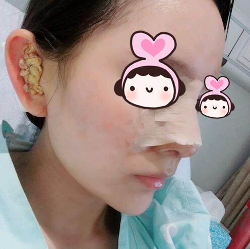 廈門(mén)海峽整形專家王翼耕做隆鼻的心得體會(huì)，王翼耕做隆鼻效果怎么樣？