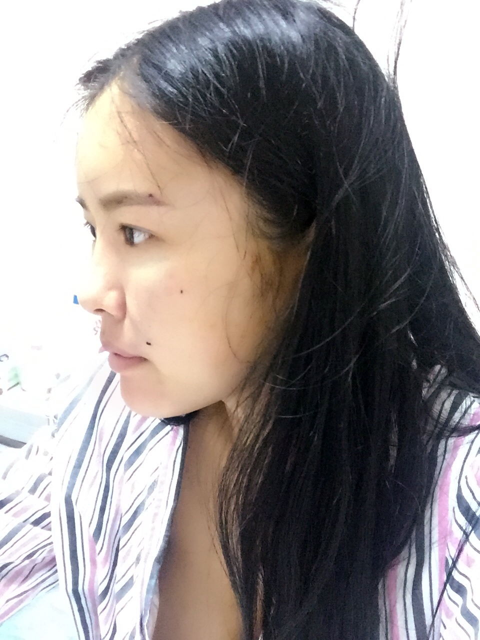 西安莎曼妃醫(yī)療美容醫(yī)院醫(yī)生樸俊做自體脂肪豐太陽穴效果怎么樣?