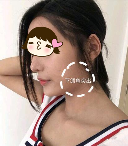 滄州瑞美醫(yī)療整形專家張鵬做下頜角磨骨整形技術(shù)怎么樣？附案例