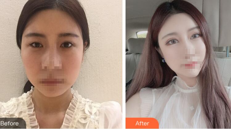 北京彤美整形醫(yī)院專家李長(zhǎng)賦做鼻部綜合整形怎么樣?李長(zhǎng)賦鼻綜合案例反饋 北京彤美整形醫(yī)院專家李長(zhǎng)賦做鼻部綜合整形怎么樣?李長(zhǎng)賦鼻綜合案例反饋