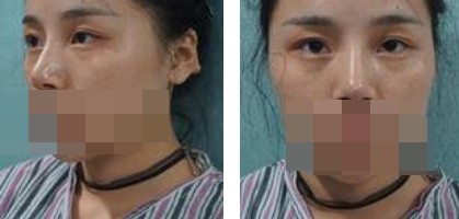 寧波美仁整形美容醫(yī)院李英大醫(yī)生做切開(kāi)雙眼皮效果怎么樣？