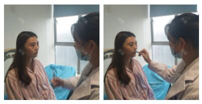 上海首爾麗格整形醫(yī)生魯峰一做自體脂肪全臉填充效果怎么樣？