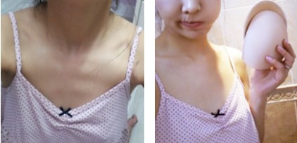 沈陽杏林整形美容醫(yī)院崔昌墉醫(yī)生做假體隆胸技術(shù)怎么樣？附案例