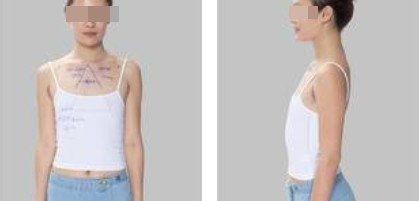 假體隆胸圓了我的豐胸夢(mèng)