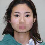 做了雙眼皮手術(shù)，讓我的眼睛更有神