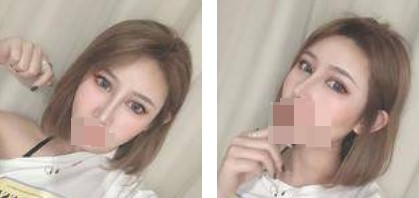 鼻綜合+眼綜合整形，讓我美的更自然，再也不用p圖了