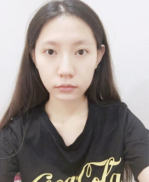  濟(jì)南安美醫(yī)療整形醫(yī)生李思思做下頜角整形怎么樣？李思思下頜角整形案例