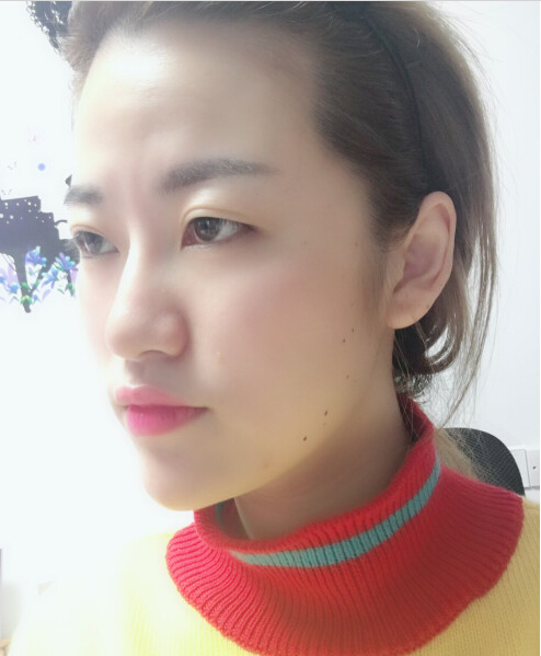 成都藝星陳遠琨醫(yī)生注射肉毒素瘦臉效果案例對比圖 成都藝星陳遠琨醫(yī)生注射肉毒素瘦臉效果案例對比圖
