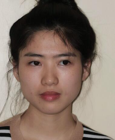 北京彤美整形醫(yī)院趙彤醫(yī)生做下頜角整形怎么樣？下頜角整形案例展示