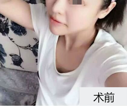 深圳博美整形醫(yī)生劉超做自體脂肪隆胸怎么樣？自體脂肪隆胸案例