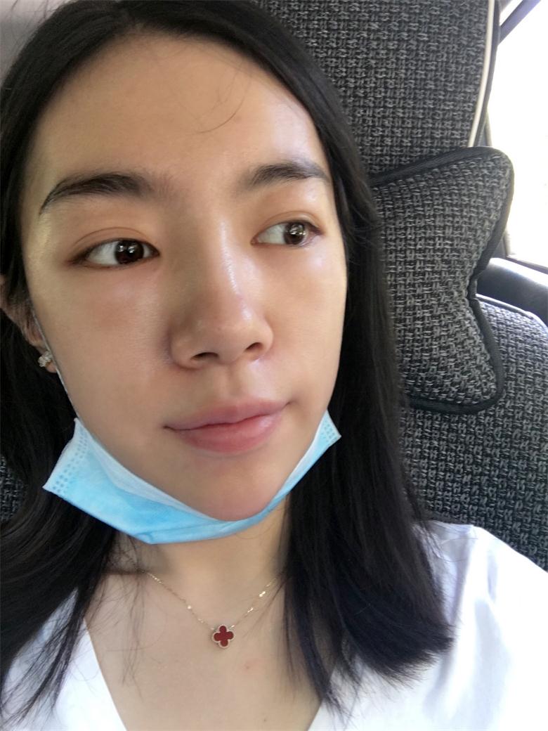 合肥壹加壹整形美容醫(yī)院做祛眼袋效果怎么樣？金大生祛眼袋案例分享