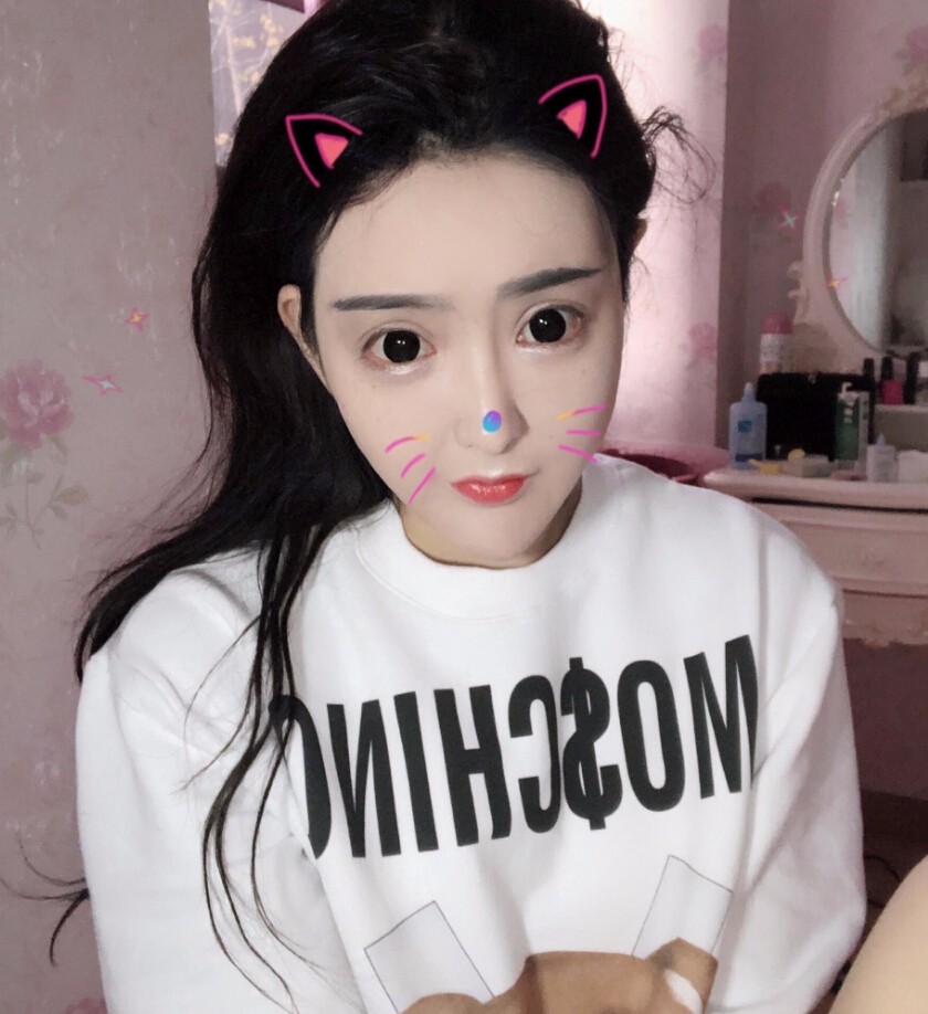 重慶柏漫醫(yī)療美容診所高紅艷醫(yī)生做面部吸脂怎么樣？面部吸脂案例分享