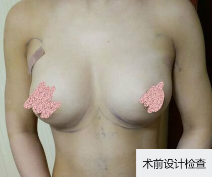 深圳博美整形醫(yī)生劉超做自體脂肪隆胸怎么樣？自體脂肪隆胸案例