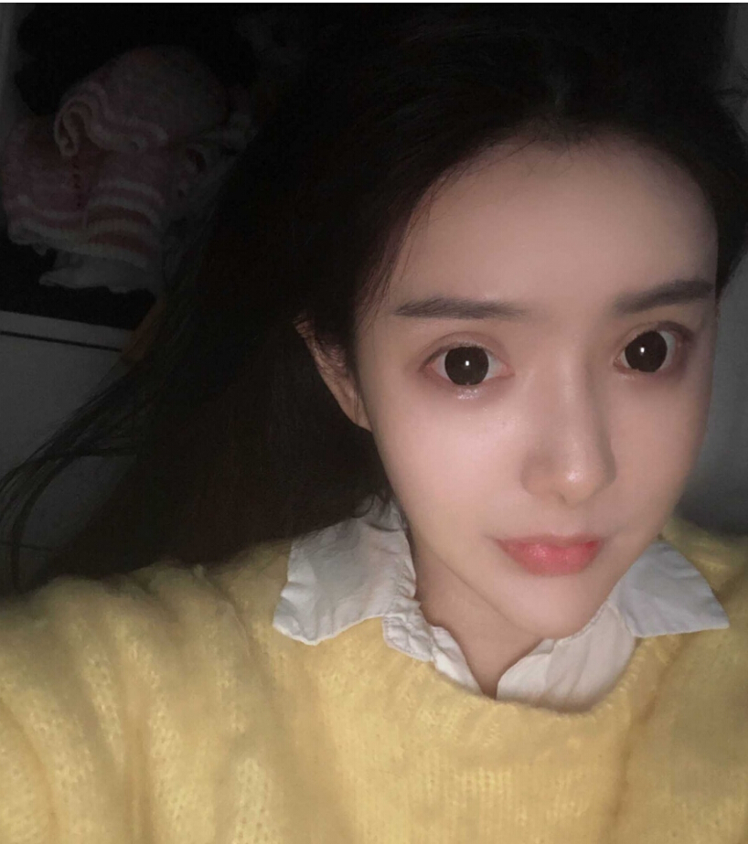 重慶柏漫醫(yī)療美容診所高紅艷醫(yī)生做面部吸脂怎么樣？面部吸脂案例分享