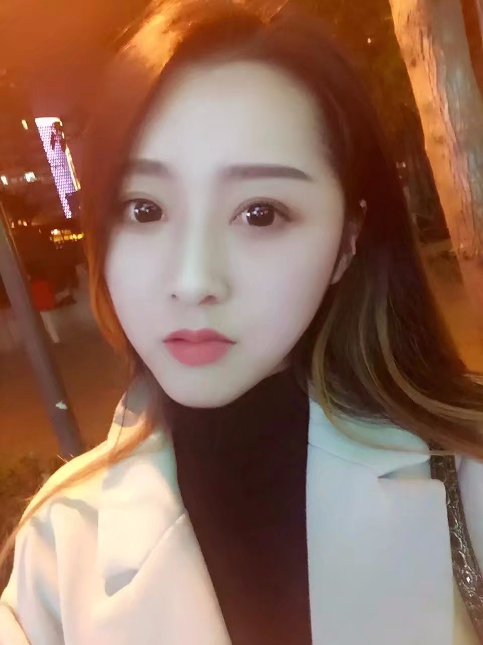 西安米蘭柏羽整形醫(yī)院李旭平做切開雙眼皮效果怎么樣？附案例