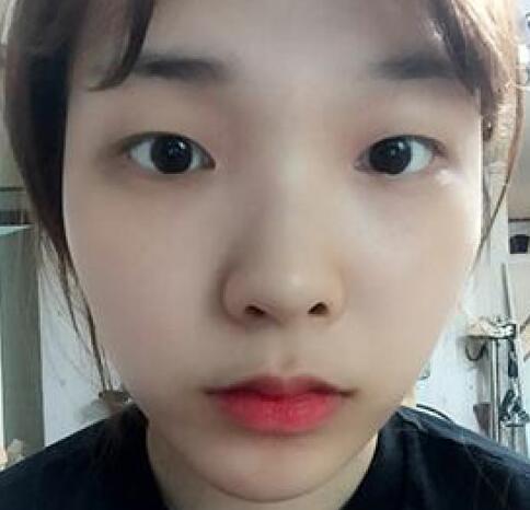 象山華美整形美容醫(yī)院趙誠厚醫(yī)生做切開雙眼皮+開內眼角整形案例