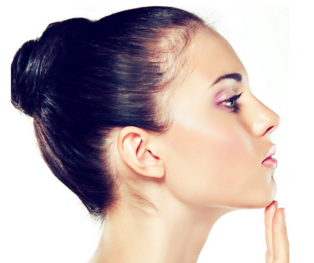 慈溪悅爾整形醫(yī)院假體隆鼻