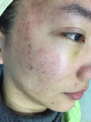 重慶柏漫醫(yī)療美容診所做激光祛痘效果怎么樣？白亞亞激光祛痘案例