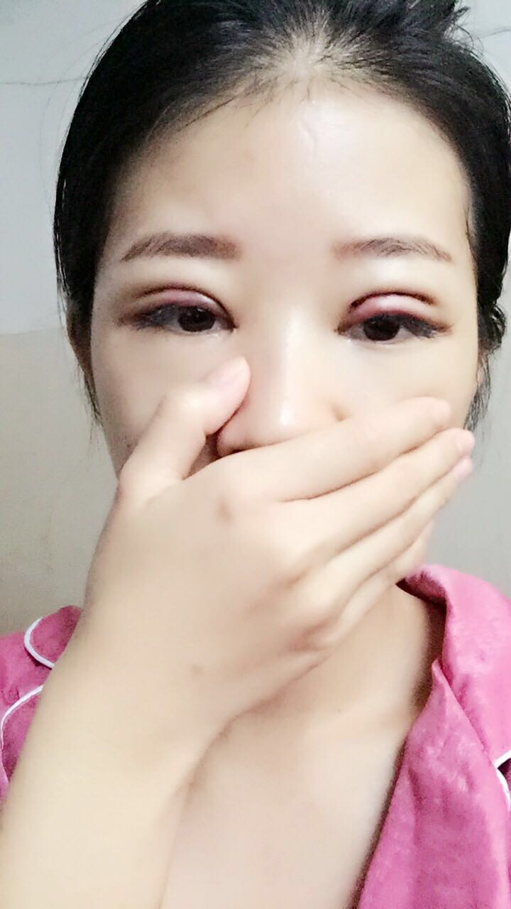 深圳晨曦醫(yī)療整形醫(yī)生吉米斯做切開雙眼皮怎么樣？吉米斯切開雙眼皮案例效果