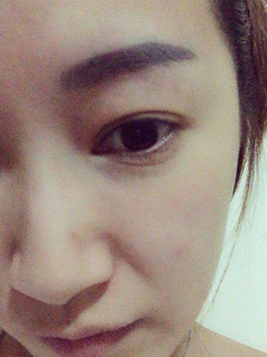 重慶五洲女子醫(yī)院整形美容中心做光子嫩膚怎么樣？淡明斌醫(yī)生光子嫩膚案例