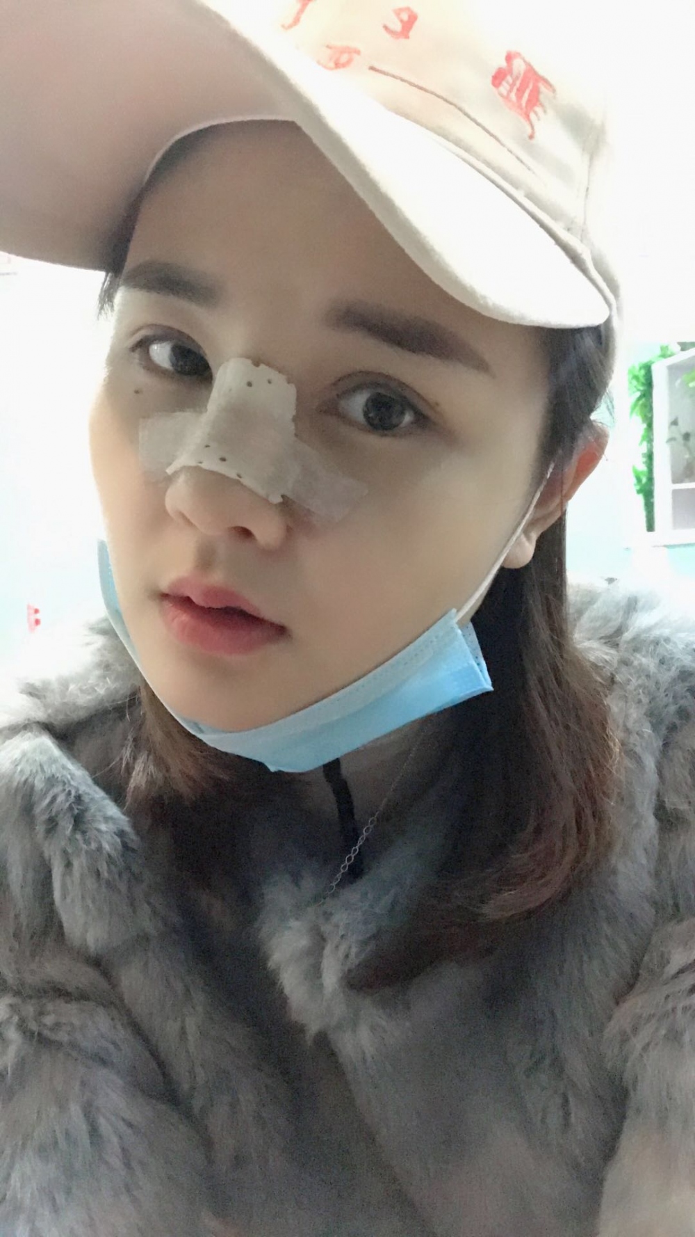 鄭州華領(lǐng)醫(yī)療美容醫(yī)院賀小虎醫(yī)生做眼綜合+鼻部整形手術(shù)效果怎么樣？
