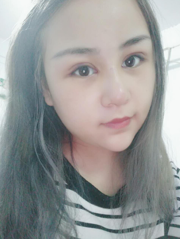 鄭州美麗時(shí)光整形醫(yī)生馬戰(zhàn)勝做雙眼皮+隆胸案例效果對(duì)比圖