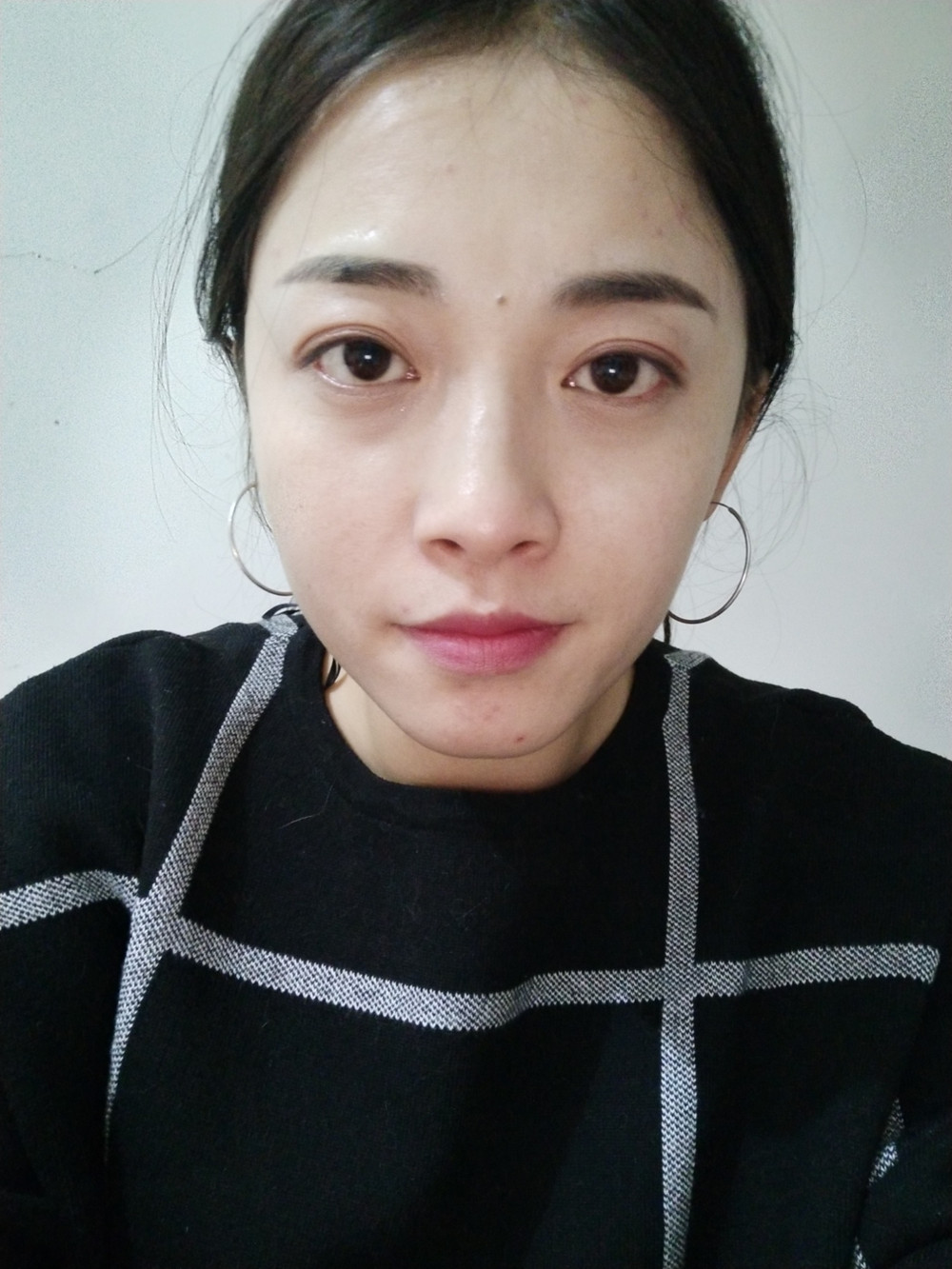 重慶當(dāng)代整形李敏旭醫(yī)生做皮秒激光祛斑效果怎么樣？附皮秒激光祛斑案例