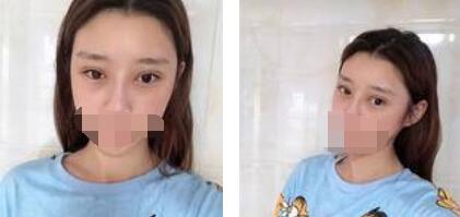 太原歐美蓮整形醫(yī)院丁曉峰醫(yī)生做雙眼皮怎么樣？丁曉峰雙眼皮手術(shù)案例分享