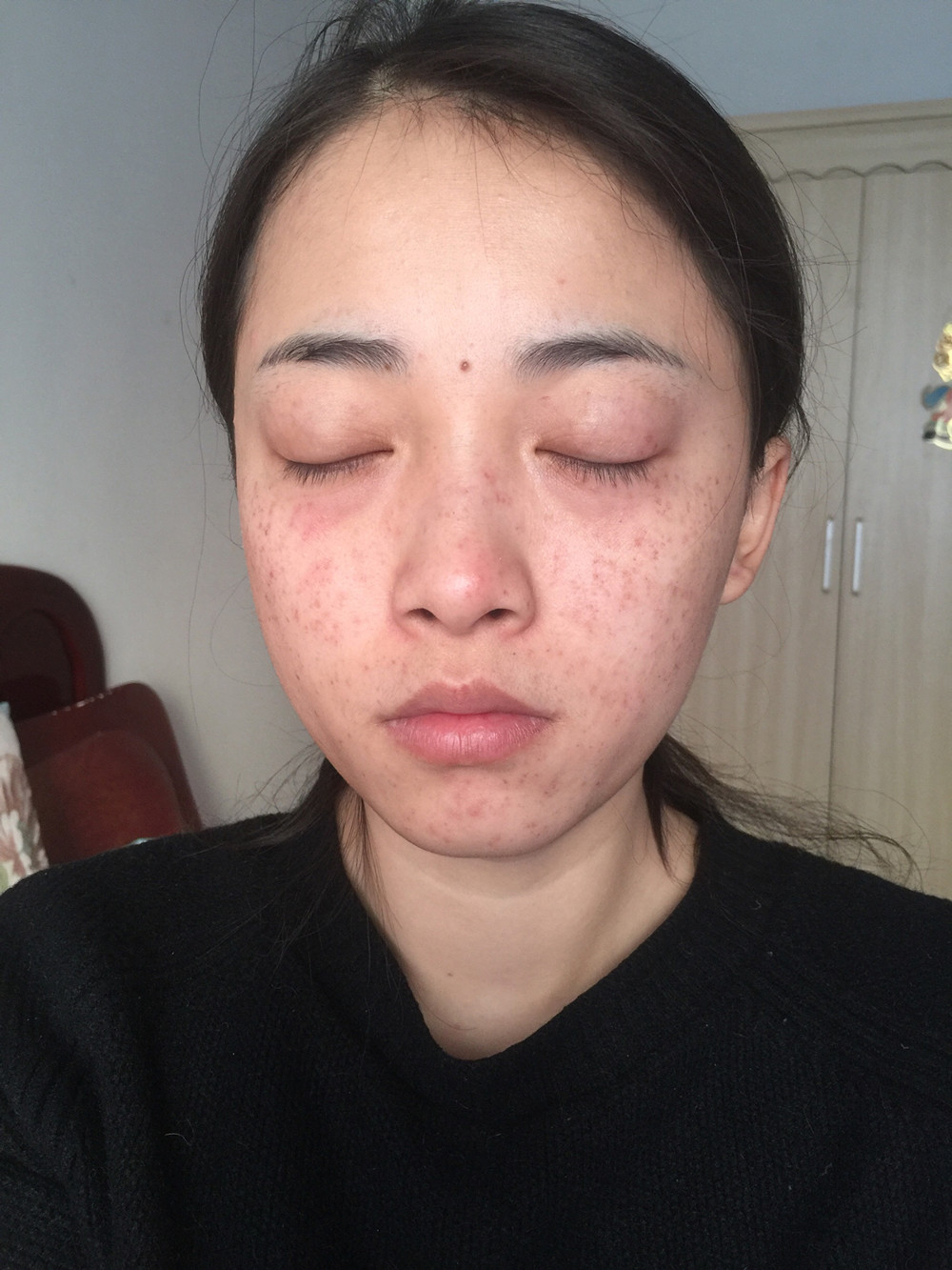 重慶當(dāng)代整形李敏旭醫(yī)生做皮秒激光祛斑效果怎么樣？附皮秒激光祛斑案例