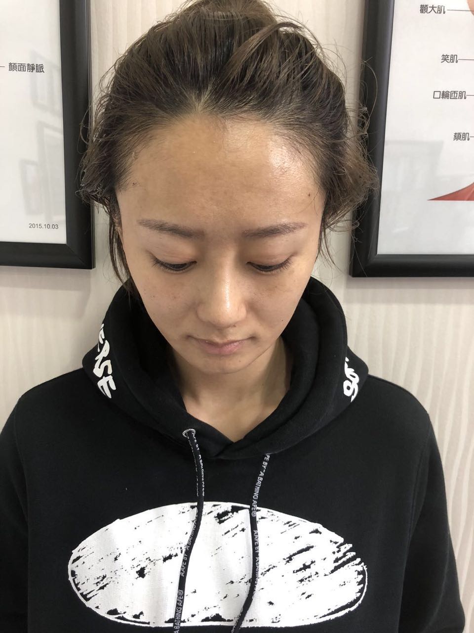 杭州迪美整形常德成醫(yī)生做鼻綜合整形技術(shù)怎么樣？附鼻綜合整形案例