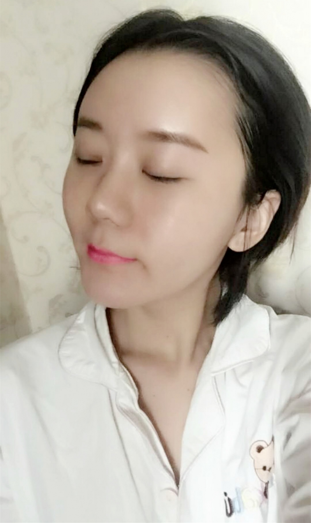 沈陽(yáng)友誼整形美容醫(yī)院金顕哲醫(yī)生做自體脂肪填充臉部+V-LINE瓜子臉手術(shù)案例效果圖