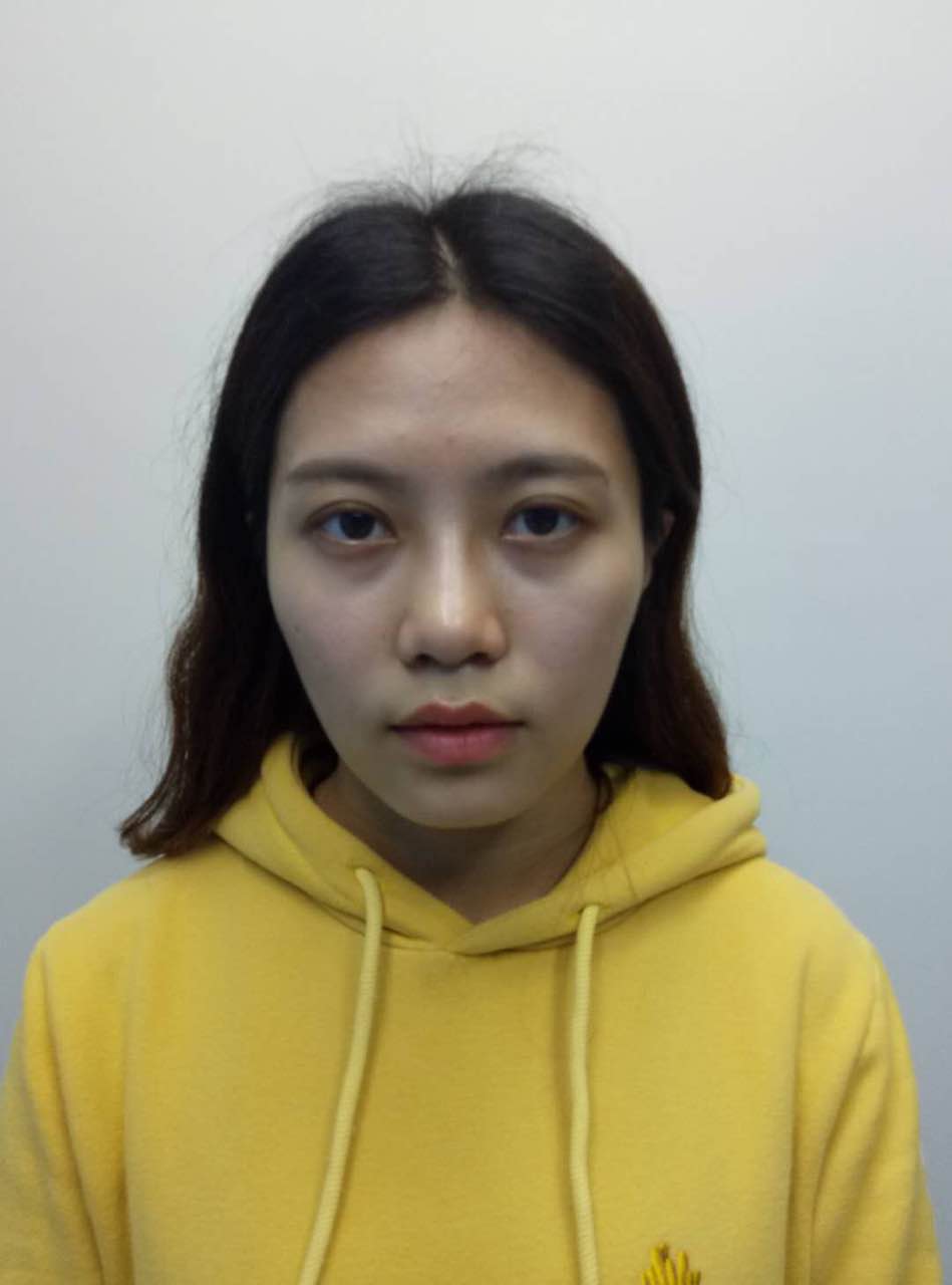 重慶美圣美邦整形醫(yī)院劉力維醫(yī)生做自體脂肪全臉填充案例效果對比圖