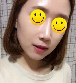 信陽東方藝美容醫(yī)院劉力萌做玻尿酸去法令紋效果怎么樣？附案例效果對比圖