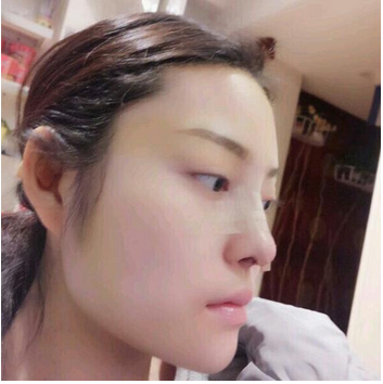 武漢維納斯整形醫(yī)院韓國濤醫(yī)生做鼻綜合整形怎么樣？附鼻綜合整形案例