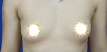 慈溪悅爾整形醫(yī)院趙天宇做自體脂肪隆胸怎么樣？附自體脂肪隆胸案例