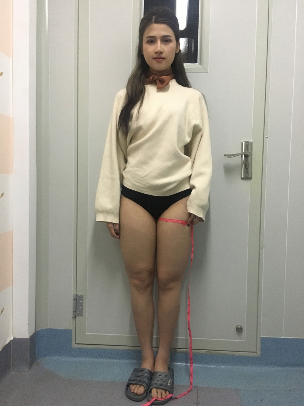 晉城鳳凰整形美容醫(yī)院宋發(fā)興醫(yī)生做大腿吸脂怎么樣？附大腿吸脂案例