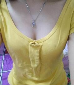 慈溪悅爾整形醫(yī)院趙天宇做自體脂肪隆胸怎么樣？附自體脂肪隆胸案例